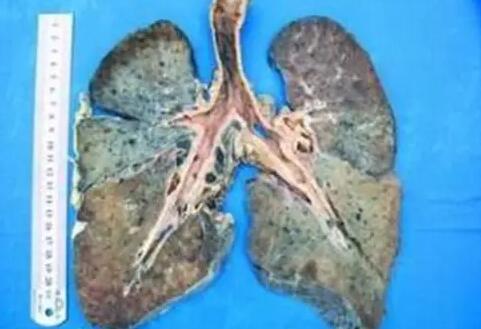 烟尘肺病——焊接樱花草视频在线观看高清免费7